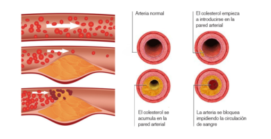 colesterol ldl