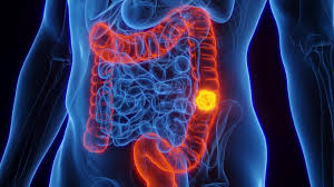 cancer de colon sintomas iniciales