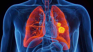Cancer de pulmon