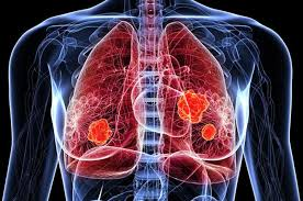 causas del cancer de pulmon