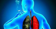 Cancer de pulmon
