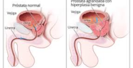 Cancer de prostata
