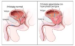 Cancer de prostata