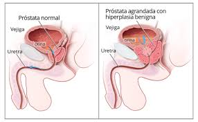 cancer de prostata