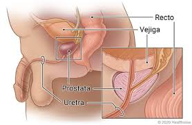 Sintomas del cancer de prostata