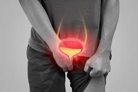 Etapas del cancer de prostata