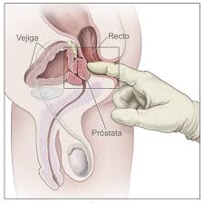 Tratamiento para el cancer de prostata