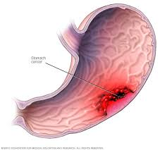 Cancer de estomago sintomas