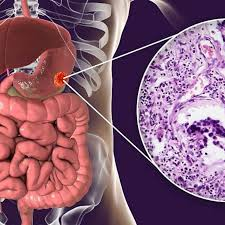 Cancer de estomago tiene cura