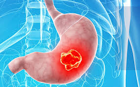 cancer de estomago sintomas en mujeres