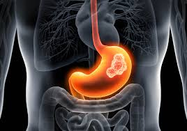 cancer de estomago pronosticos