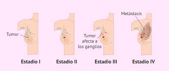 Que es el cancer de mama