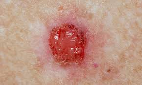 cancer de piel tiene cura