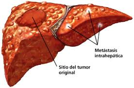 sintomas del cancer de higado