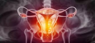 Cancer de cuello uterino