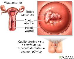 tipos de cancer de cuello uterino