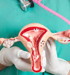 cancer de cuello uterino