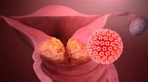 etapas del cancer de cuello uterino