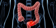 Cancer de colon
