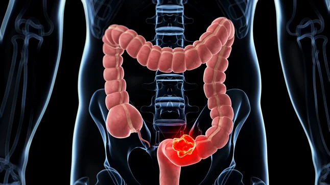 Cancer de colon