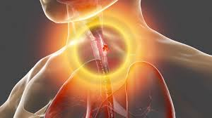 Cancer de esofago sintomas