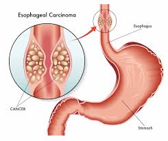 cancer de esofago causas