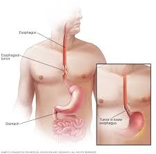 cancer de esofago pronosticos