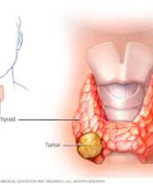 Cancer de tiroides