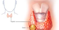 Cancer de tiroides