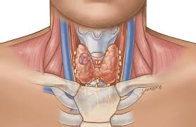 Tipos de cancer de tiroides