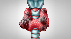 Cancer de tiroides tiene cura