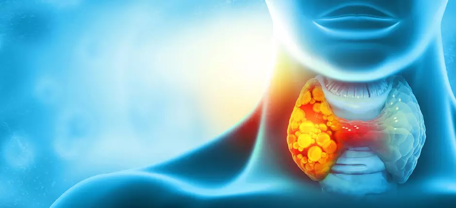 cancer de tiroides etapas