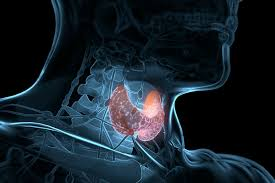 Cancer de tiroides es mortal