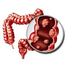 causas del cancer de colon