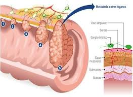 Cancer de colon etapas